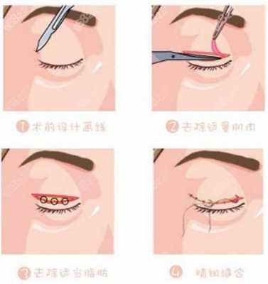 全切双眼皮手术过程图（全切双眼皮手术步骤）-图2