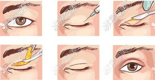 全切双眼皮手术过程图（全切双眼皮手术步骤）-图3