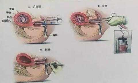 女人刮宫的手术过程（女性刮宫需要多少费用）-图1