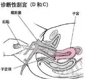 女人刮宫的手术过程（女性刮宫需要多少费用）-图3