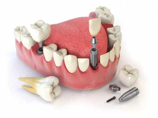正牙手术过程（正牙术多少钱）-图2