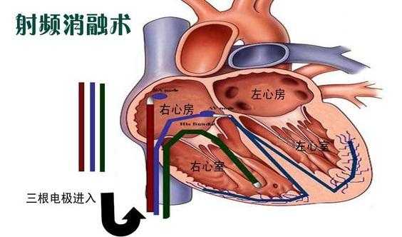 心脏的过程（心脏过程射频消融）-图1