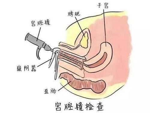 宫腔镜结扎过程（宫腔镜结扎输卵管手术视频全过程）-图1