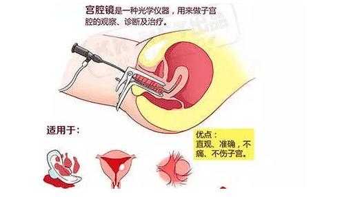 宫腔镜结扎过程（宫腔镜结扎输卵管手术视频全过程）-图3