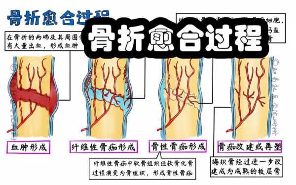 骨折愈合的过程包括（骨折愈合的过程包括多选题）-图3